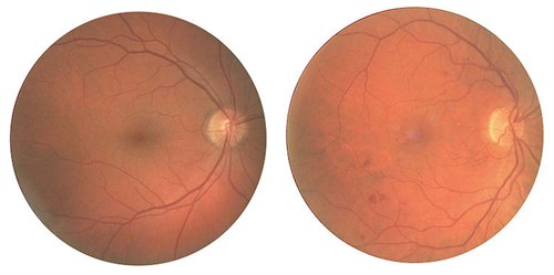 Fundus photograph