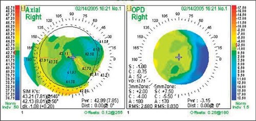 Corneal topography