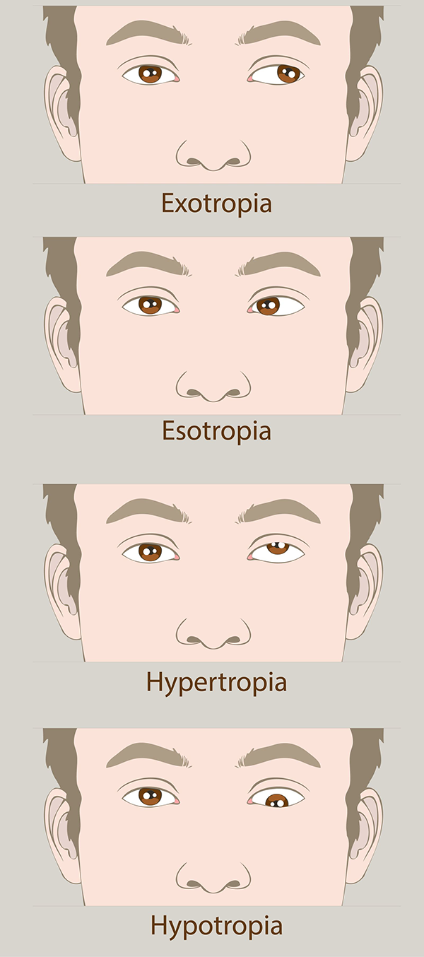 Amblyopia