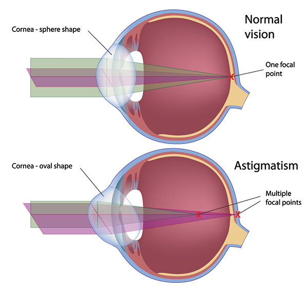 Astigmatism