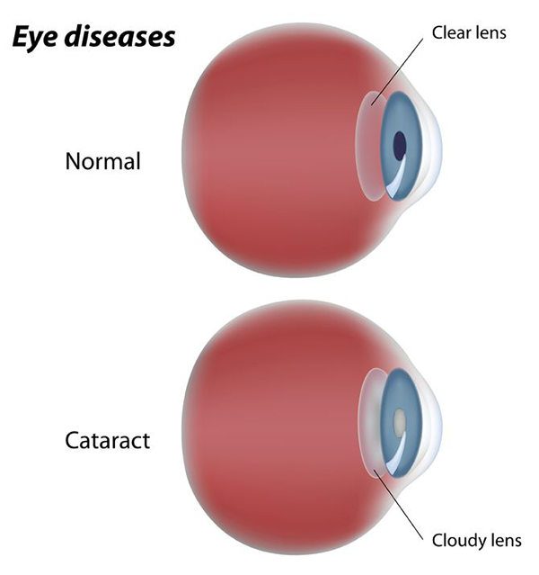 Cataracts