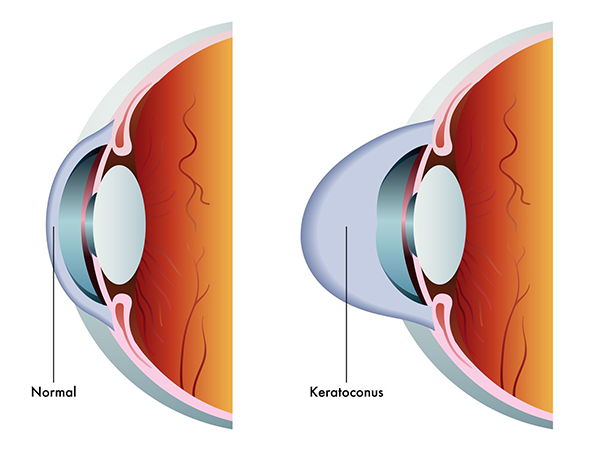 Keratoconus