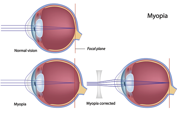 Nearsightedness