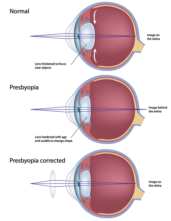 Presbyopia