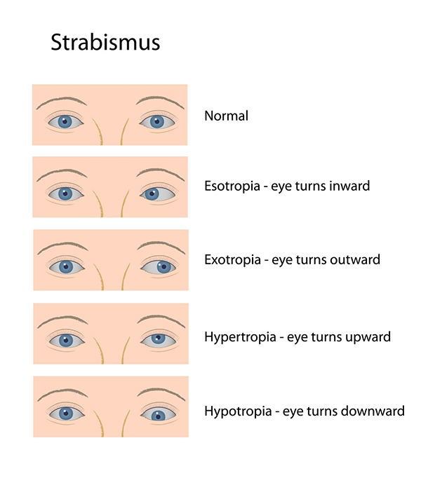 https://www.eyecare-midtown.com/images/optical-library-images/strabismus.png